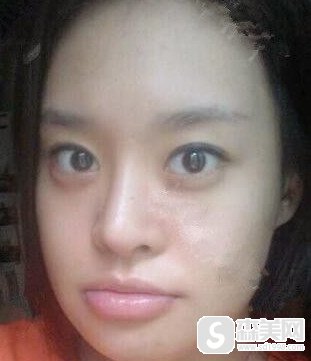 【下巴截骨前移+下巴截骨缩短】宋茂启的精选的截骨案例的分享