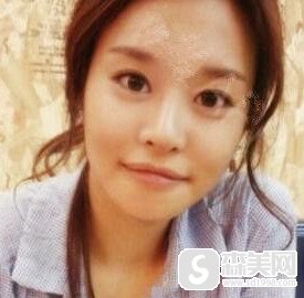 【下巴截骨前移+下巴截骨缩短】宋茂启的精选的截骨案例的分享