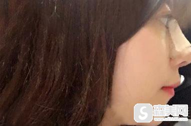 鼻翼缩小整容怎么样?附鼻翼缩小案例分享