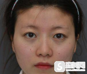 鼻翼缩小整容怎么样?附鼻翼缩小案例分享