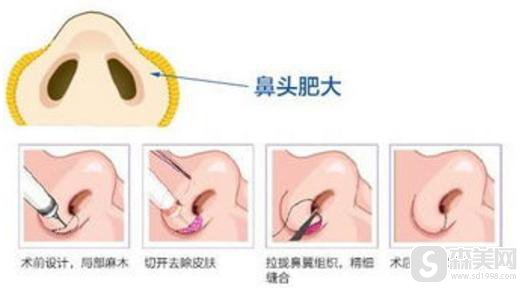 鼻翼过宽是什么？如何矫正？附鼻翼过宽矫正 案例前后果对比图