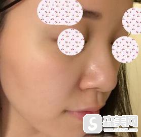 鼻翼过宽是什么？如何矫正？附鼻翼过宽矫正 案例前后果对比图