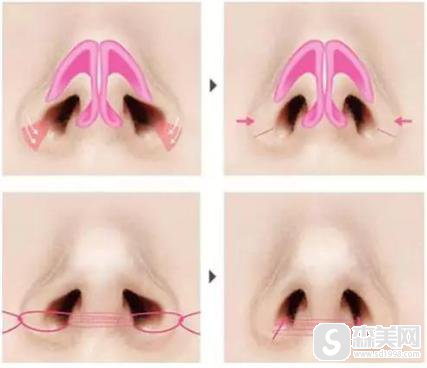 鼻翼过宽是什么？如何矫正？附鼻翼过宽矫正 案例前后果对比图