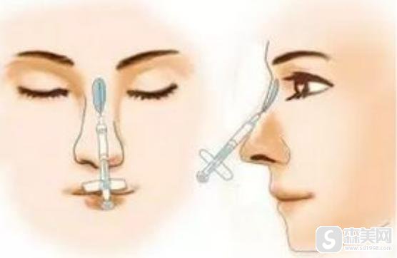 玻尿酸隆鼻可以维持多久？附玻尿酸隆鼻案例分享