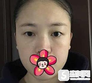 全切双眼皮怎么样?附全切双眼皮案例分享