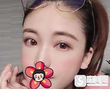 全切双眼皮怎么样?附全切双眼皮案例分享