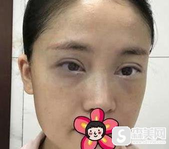 全切双眼皮怎么样?附全切双眼皮案例分享