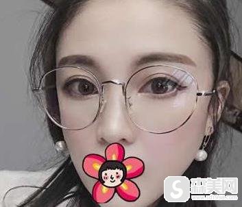 全切双眼皮怎么样?附全切双眼皮案例分享