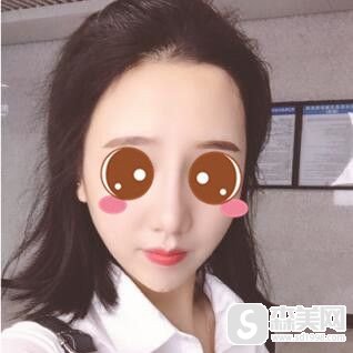 首都医科大学附属北京朝阳医院好不好?鼻部手术手术完成后让我变的特别的精致