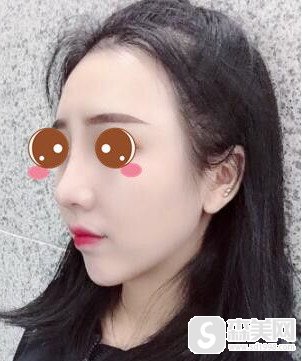 首都医科大学附属北京朝阳医院好不好?鼻部手术手术完成后让我变的特别的精致