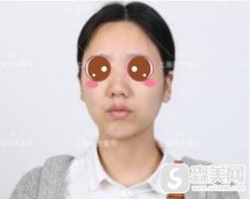 首都医科大学附属北京朝阳医院好不好?鼻部手术手术完成后让我变的特别的精致