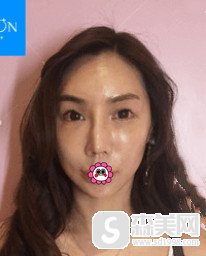 上海九院俞哲元医生比较擅长哪些手术?整形手术的果怎么能改变颜值吗?