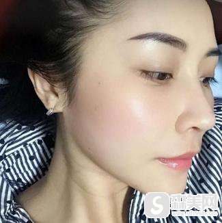 眼尾纹除皱较好的方式是什么?附眼尾纹除皱案例