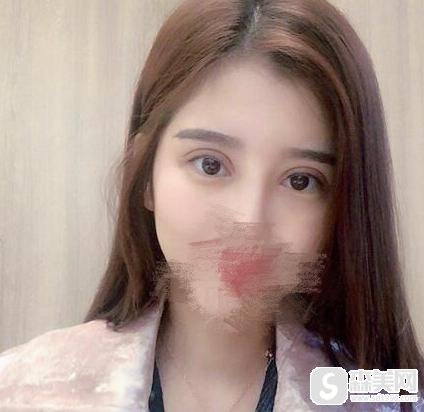 警惕!整形手术要小心,做好准备再去做,附割双眼皮失败案例图片