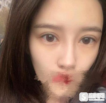 警惕!整形手术要小心,做好准备再去做,附割双眼皮失败案例图片