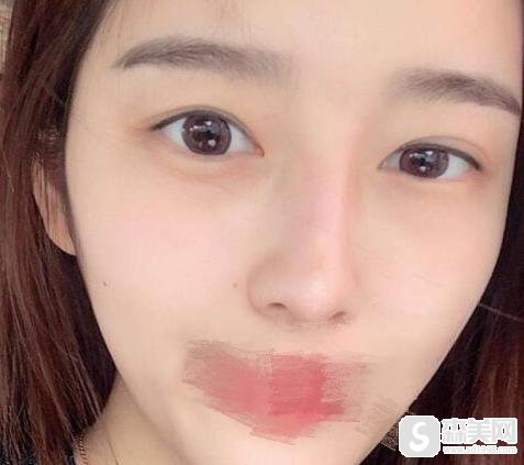 警惕!整形手术要小心,做好准备再去做,附割双眼皮失败案例图片