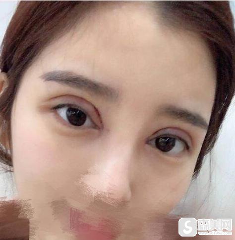 警惕!整形手术要小心,做好准备再去做,附割双眼皮失败案例图片