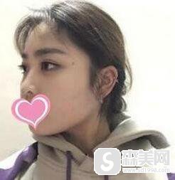 注射微晶瓷隆鼻多少钱?附微晶瓷隆鼻案例分享