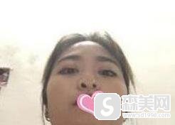 注射微晶瓷隆鼻多少钱?附微晶瓷隆鼻案例分享