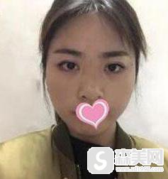 注射微晶瓷隆鼻多少钱?附微晶瓷隆鼻案例分享