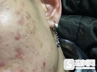 微针去痘坑怎么样？附微针去痘坑案例分享