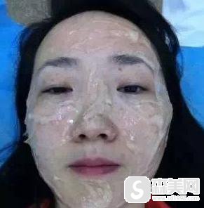 飞顿光子嫩肤好不好?附飞顿光子嫩肤案例分享