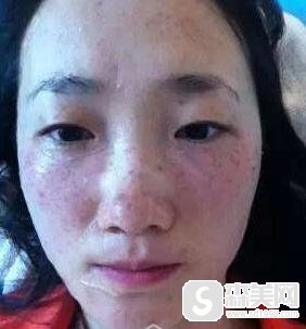 飞顿光子嫩肤好不好?附飞顿光子嫩肤案例分享