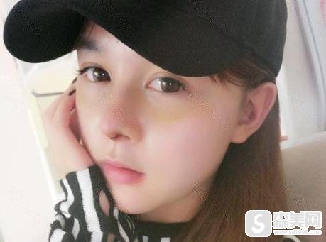 垫鼻子大概需要多少钱?附垫鼻子案例分享