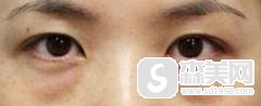 眼袋吸脂多少钱?能维持多少时间?附吸脂祛眼袋案例说明