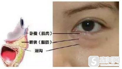 眼袋吸脂多少钱？能维持多少时间？附吸脂祛眼袋案例说明