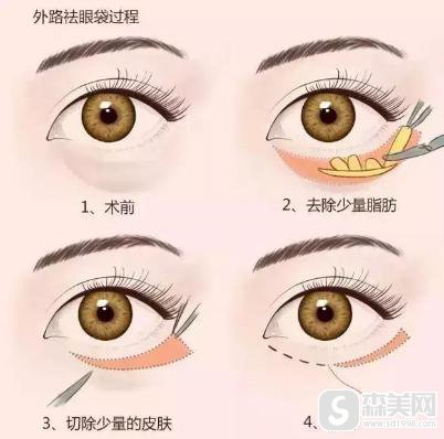 眼袋吸脂多少钱?能维持多少时间?附吸脂祛眼袋案例说明