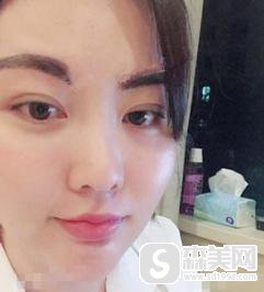 脸部抽脂价格是多少?附面部抽脂案例