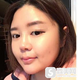 脸部抽脂价格是多少?附面部抽脂案例