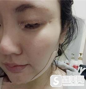 脸部抽脂价格是多少?附面部抽脂案例