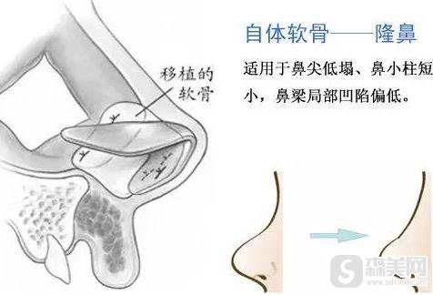 软骨垫鼻子对自身是否有影响?附软骨垫鼻子术前术后对比照片