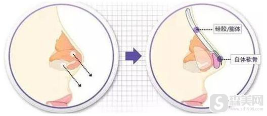 软骨垫鼻子对自身是否有影响?附软骨垫鼻子术前术后对比照片