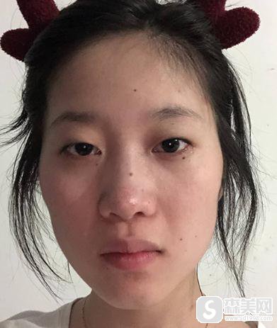 根据明星苏怡贤整容前后照片,找到了中日友好做了眼睛