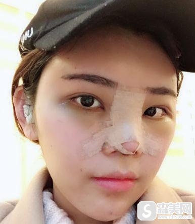 厦门莫琳娜医疗美容门诊部耳软骨隆鼻做的怎么样?附案例对比