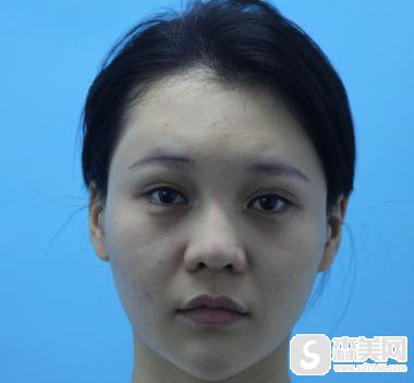 被安利了明星张歆艺整容前后照片,找到了成都八大处丰额头