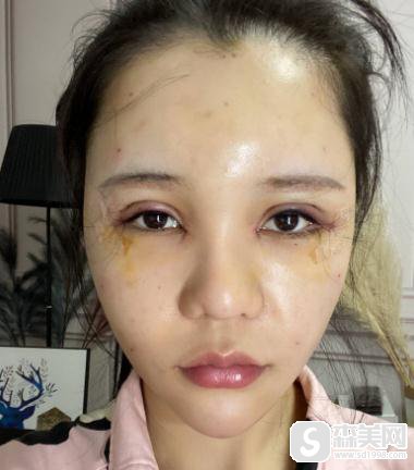 被安利了明星张歆艺整容前后照片,找到了成都八大处丰额头