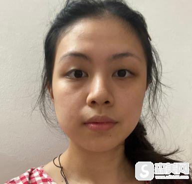 看完了明星贾青整容的照片，找到了杭州格莱美进行双眼皮手术