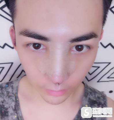 根据明星丁一宇整容前后对比照,找到了福州华美进行隆鼻