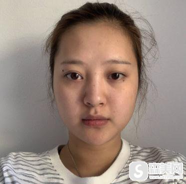 注射瘦脸打几次定型?上海九院案例前后对比图