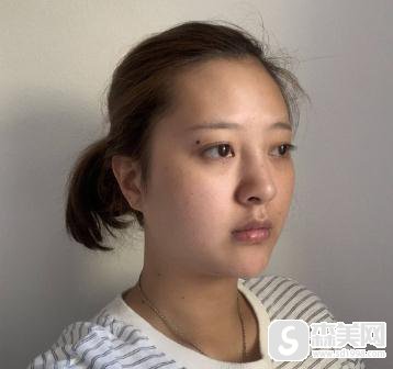 注射瘦脸打几次定型?上海九院案例前后对比图