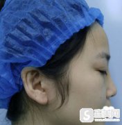 天津德尚高培修复隆鼻好吗?个人介绍和术后果对比图