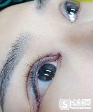 武汉开眼角来赞五洲整形,让你能够获得完美经典的美丽大眼睛!