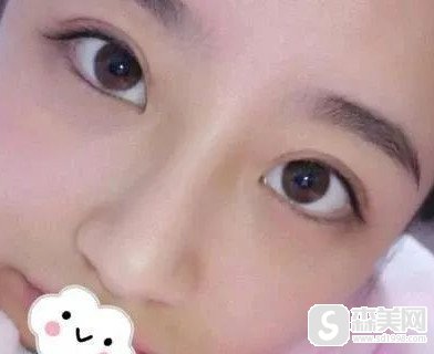 武汉开眼角来赞五洲整形,让你能够获得完美经典的美丽大眼睛!