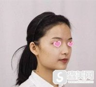扬州面部轮廓整形找张强医生就对了，轮廓改变后我变成了名副其实的软妹子!
