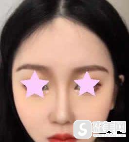 南京鼓楼医院美容科注射瘦脸价格是多少？附注射瘦脸案例分享