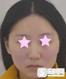 南京鼓楼医院美容科注射瘦脸价格是多少？附注射瘦脸案例分享